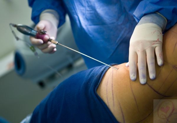 Liposuction – Liposakşın ile Yağ Aldırma Hakkında Bilgiler