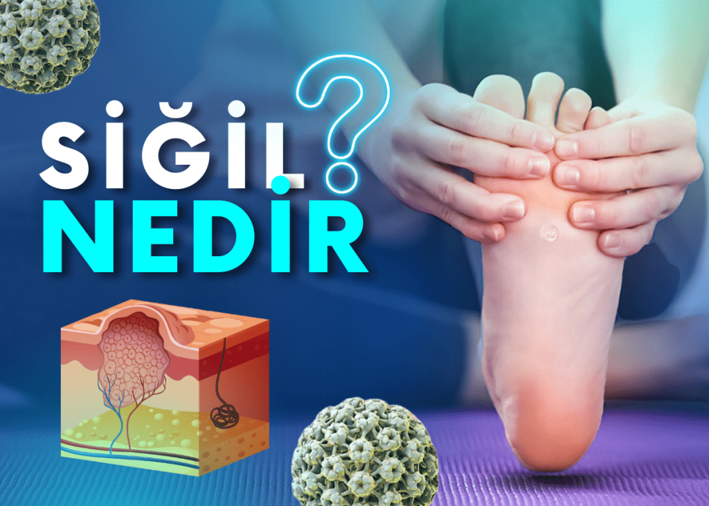 Siğil Nedir, Nasıl Oluşur ve Tedavisi Nasıl Gerçekleşir